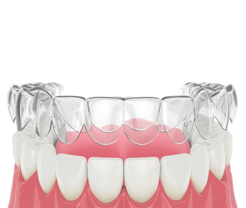 Types of Retainers: Hawley vs Essix vs Vivera