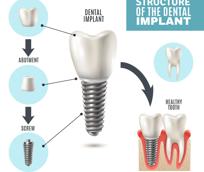 Veneers vs Implants: Which is a better option?