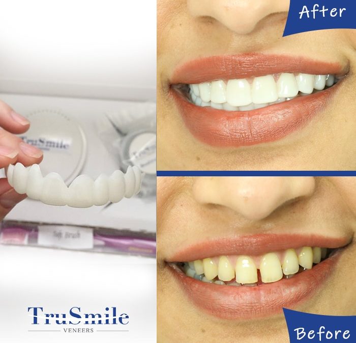 TruSmile‌ ‌Veneers‌ ‌Reviews:‌ ‌Cost,‌ ‌Procedure,‌ ‌and More