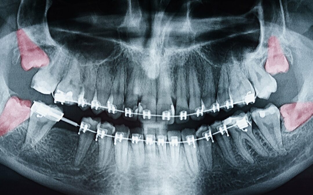 Wisdom Teeth: Pictures, Symptoms, Surgery, & Pain Relief