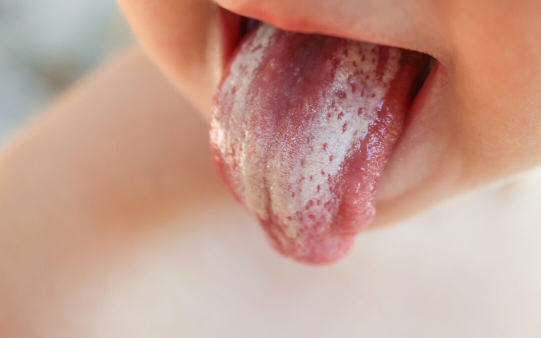 Oral Thrush: Home Remedies, Causes, Symptoms & More